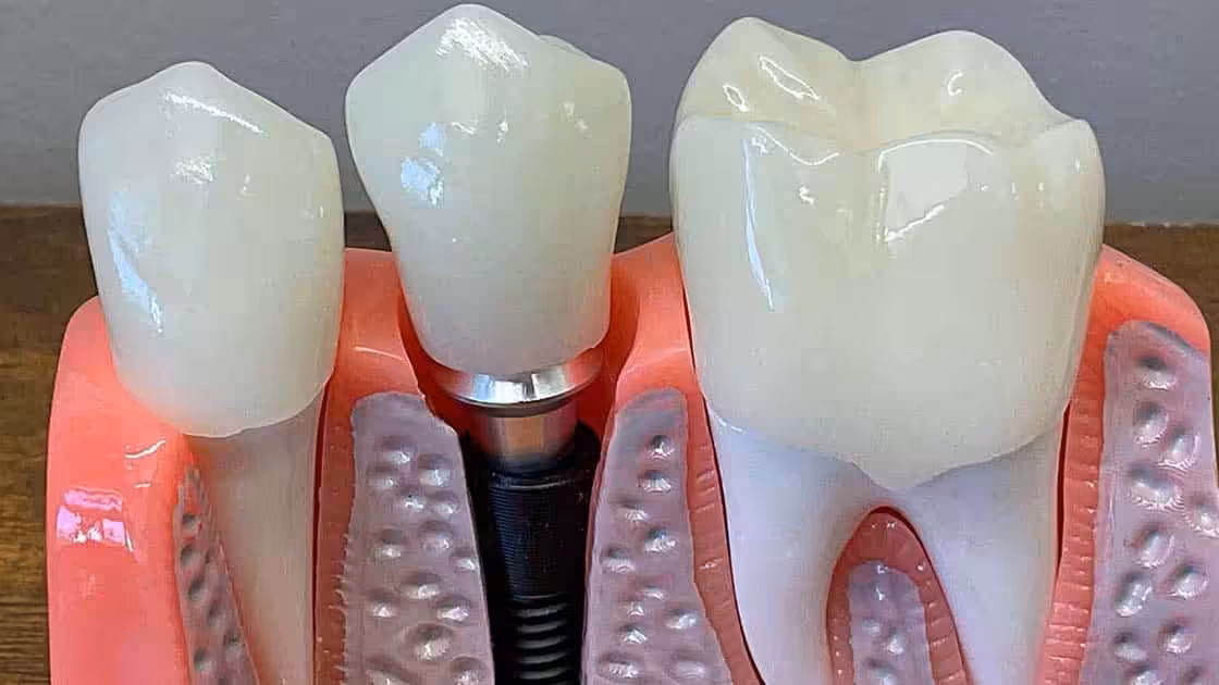 Acrylic Implants 1120x630