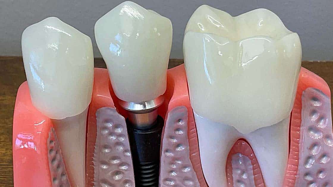 Acrylic Implants 1120x630