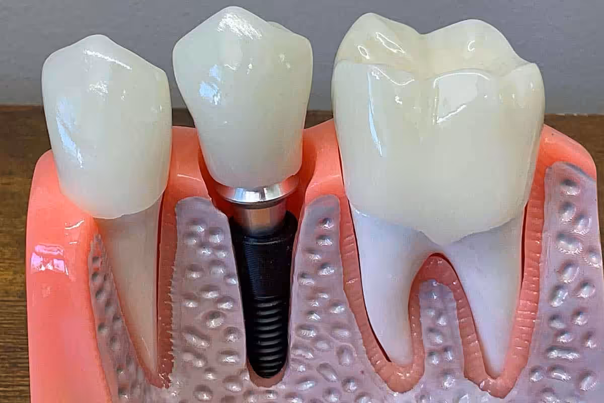 Acrylic Implants 12x8