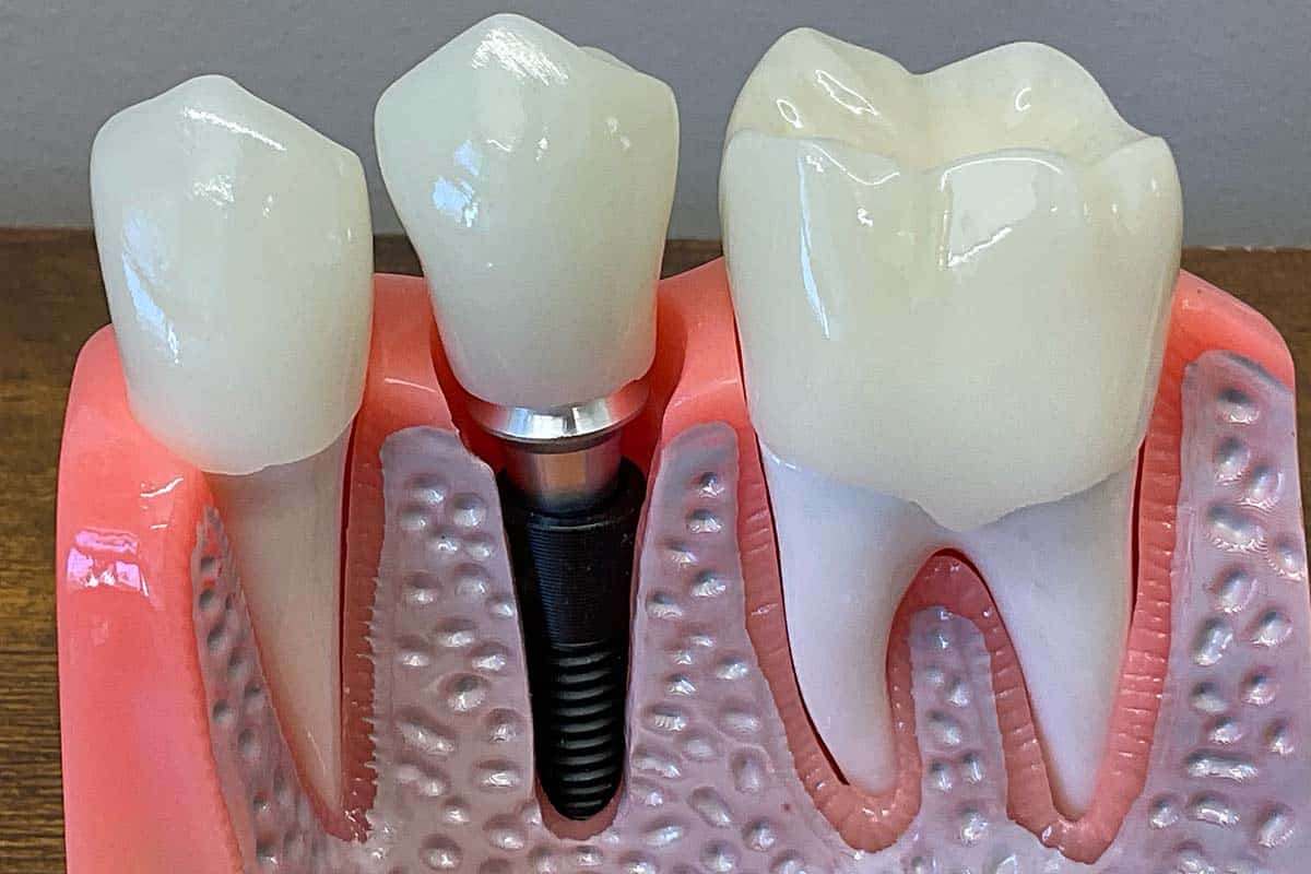 Acrylic Implants 12x8