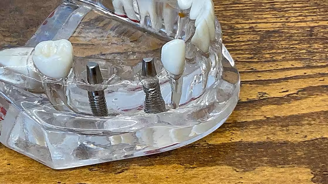 Acrylic Implant Model 1120x630