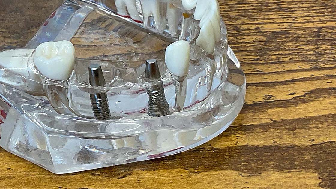 Acrylic Implant Model 1120x630