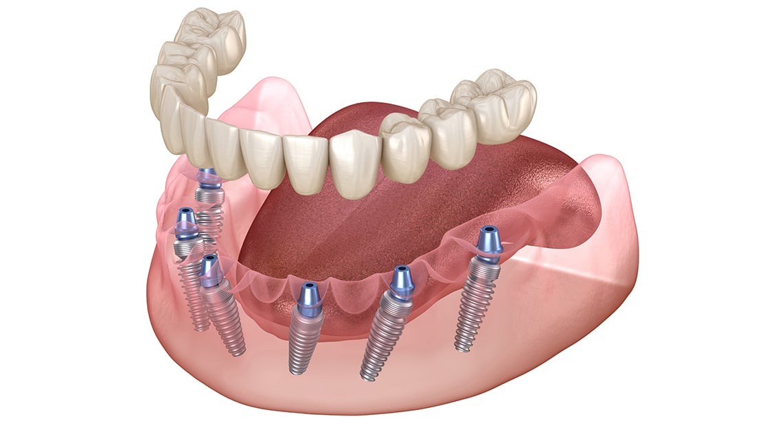 Implant Support Denture