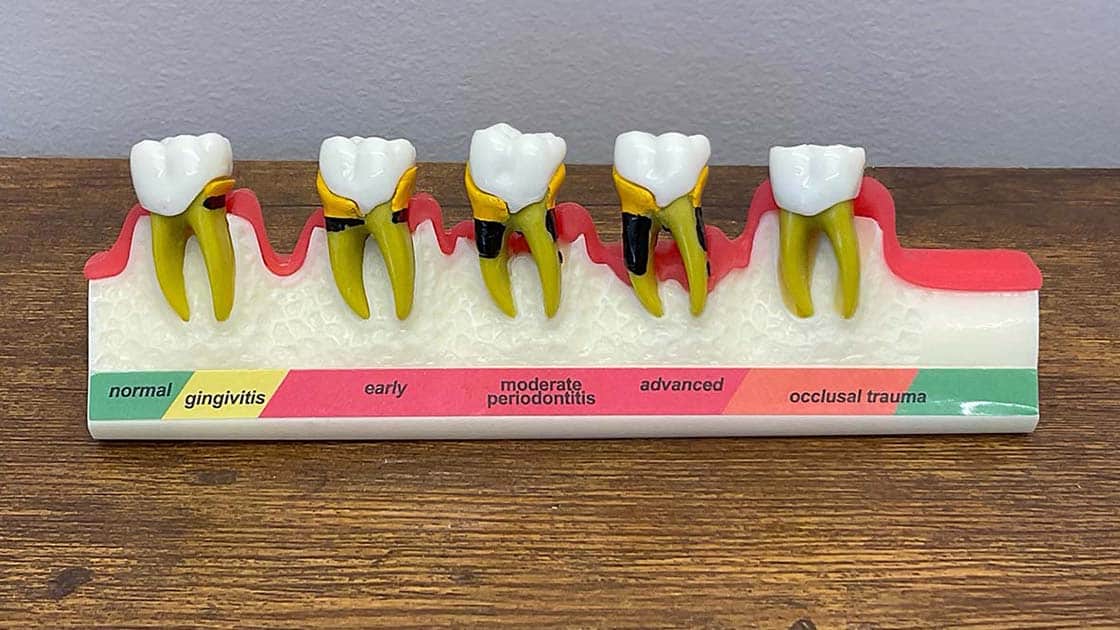 Tooth Model 1 1120x630