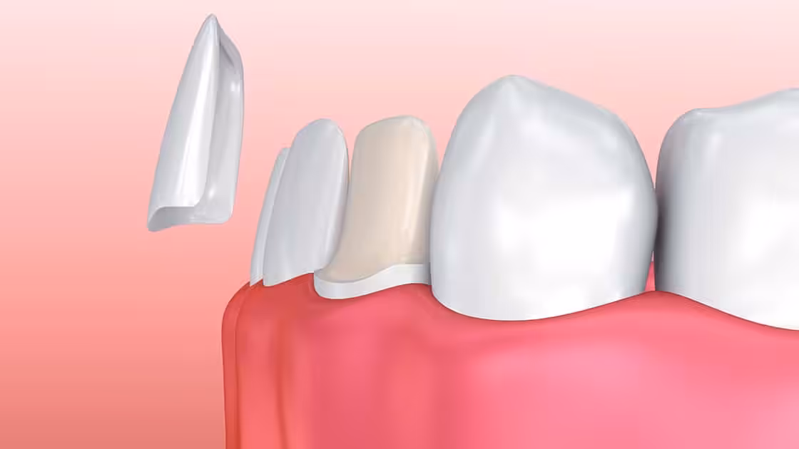 Veneers